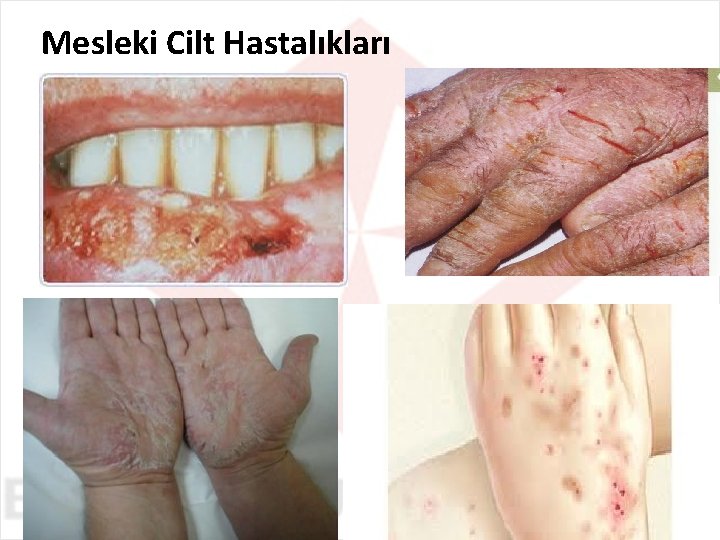 Mesleki Cilt Hastalıkları 