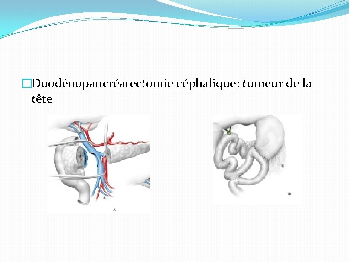 �Duodénopancréatectomie céphalique: tumeur de la tête 