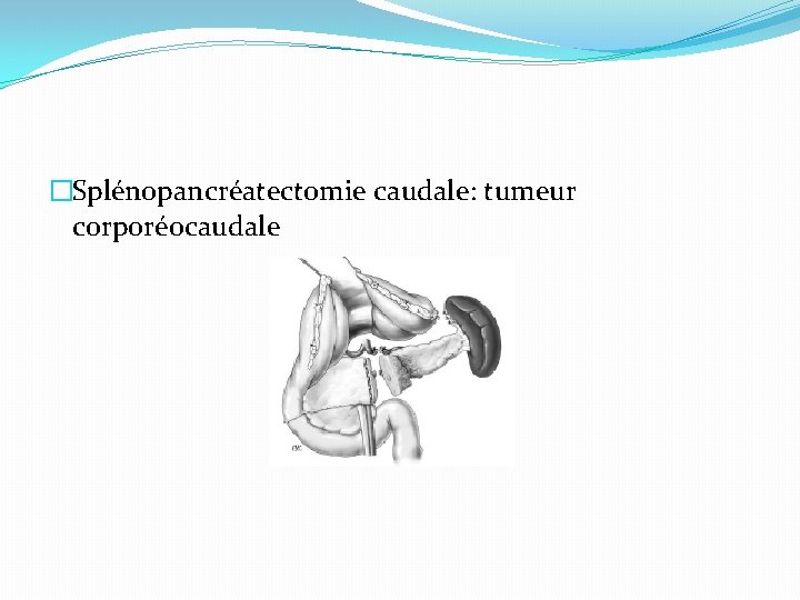 �Splénopancréatectomie caudale: tumeur corporéocaudale 