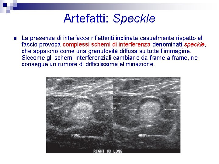 Artefatti: Speckle n La presenza di interfacce riflettenti inclinate casualmente rispetto al fascio provoca