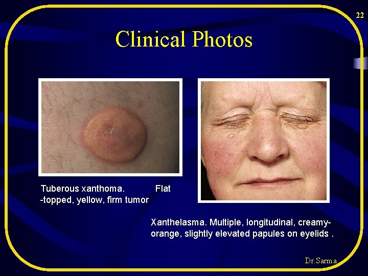 22 Clinical Photos Tuberous xanthoma. Flat -topped, yellow, firm tumor Xanthelasma. Multiple, longitudinal, creamyorange, 22 Clinical Photos Tuberous xanthoma. Flat -topped, yellow, firm tumor Xanthelasma. Multiple, longitudinal, creamyorange,