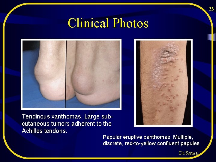 23 Clinical Photos Tendinous xanthomas. Large subcutaneous tumors adherent to the Achilles tendons. Papular 23 Clinical Photos Tendinous xanthomas. Large subcutaneous tumors adherent to the Achilles tendons. Papular