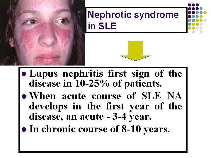 Nephrotic syndrome in SLE Lupus nephritis first sign of the disease in 10 -25%