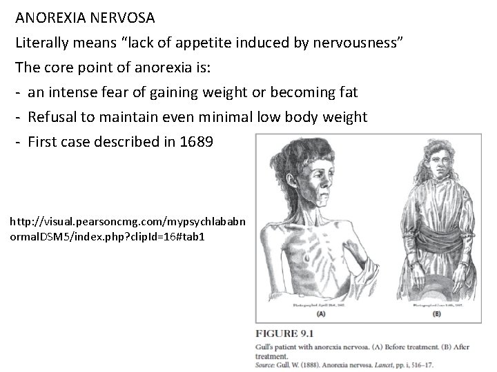 ANOREXIA NERVOSA Literally means “lack of appetite induced by nervousness” The core point of ANOREXIA NERVOSA Literally means “lack of appetite induced by nervousness” The core point of