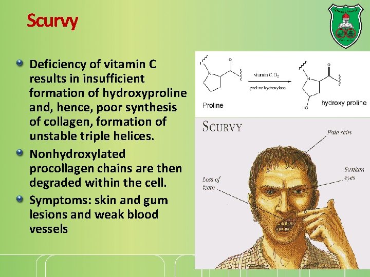 Scurvy Deficiency of vitamin C results in insufficient formation of hydroxyproline and, hence, poor
