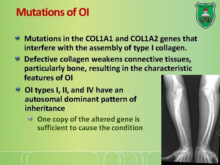 Mutations of OI Mutations in the COL 1 A 1 and COL 1 A