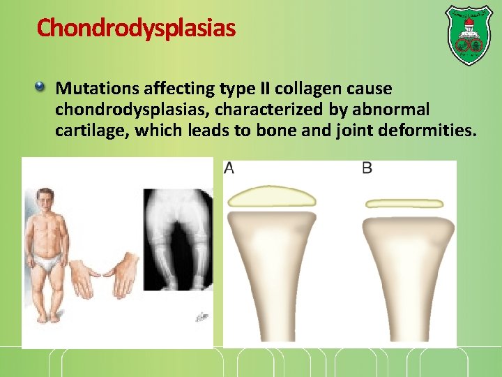 Chondrodysplasias Mutations affecting type II collagen cause chondrodysplasias, characterized by abnormal cartilage, which leads