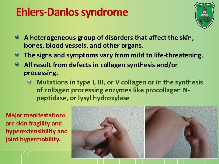 Ehlers-Danlos syndrome A heterogeneous group of disorders that affect the skin, bones, blood vessels,