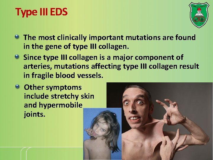 Type III EDS The most clinically important mutations are found in the gene of Type III EDS The most clinically important mutations are found in the gene of