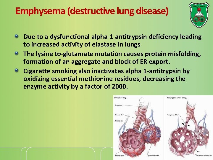 Emphysema (destructive lung disease) Due to a dysfunctional alpha-1 antitrypsin deficiency leading to increased