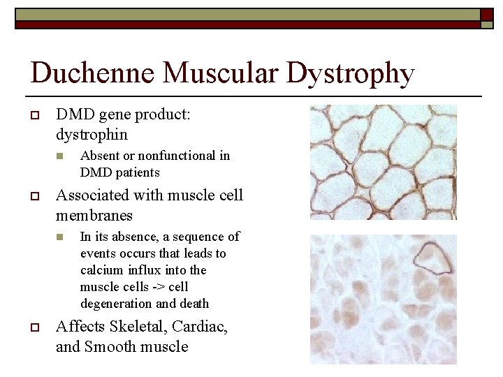 Duchenne Muscular Dystrophy o DMD gene product: dystrophin n o Associated with muscle cell