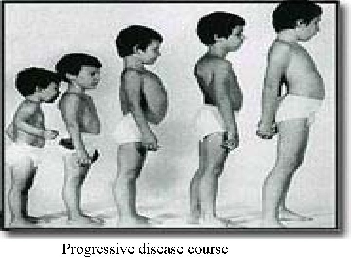 Progressive disease course 