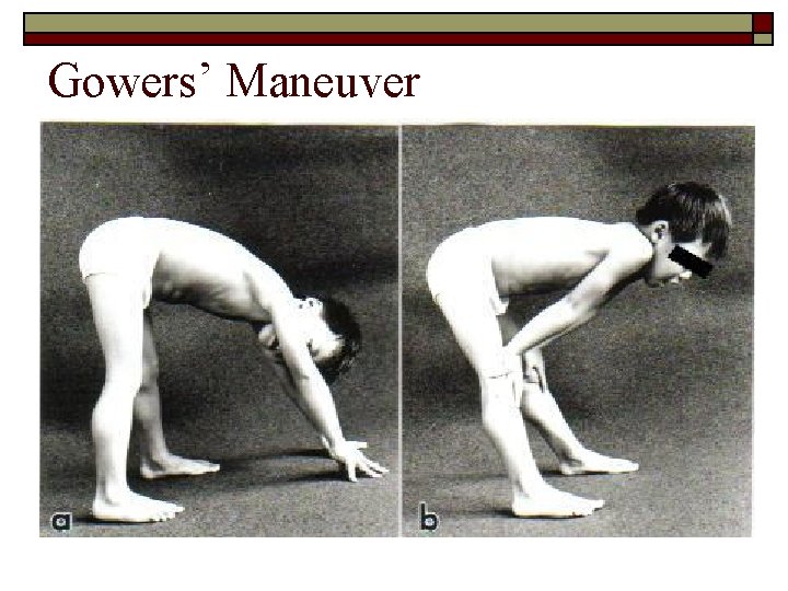Gowers’ Maneuver 