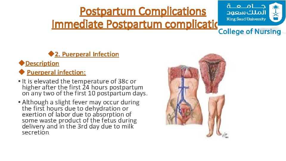 Postpartum Complications Immediate Postpartum complications. 2. Puerperal Infection Description Puerperal infection: • It is