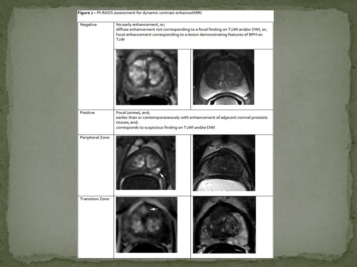 Prosztata hiperplázia MRI