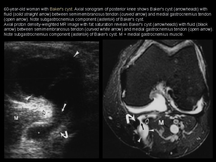 60 -year-old woman with Baker's cyst. Axial sonogram of posterior knee shows Baker's cyst