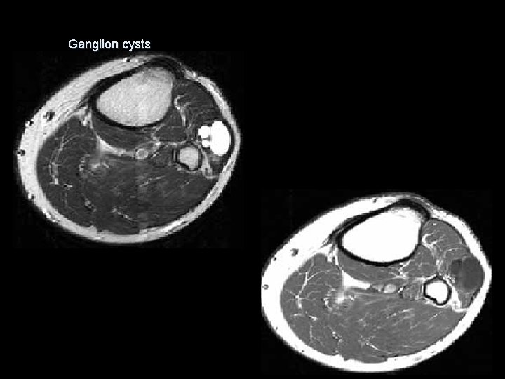 Ganglion cysts 