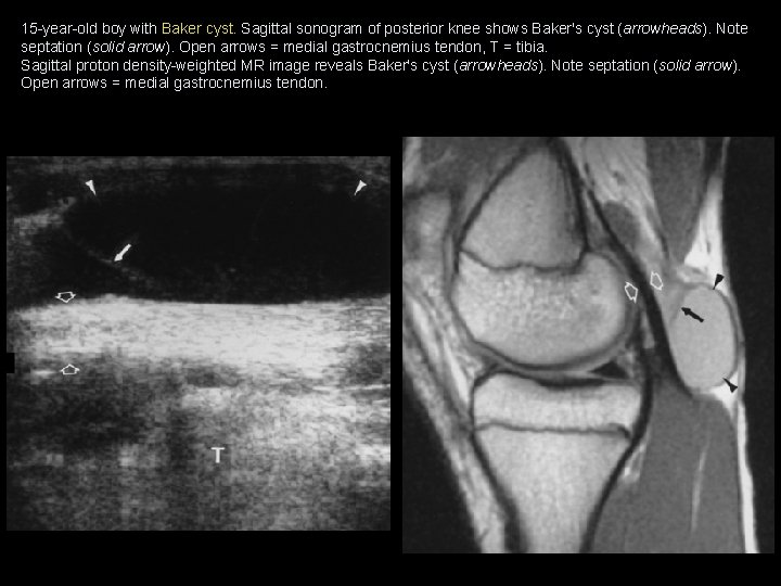 15 -year-old boy with Baker cyst. Sagittal sonogram of posterior knee shows Baker's cyst