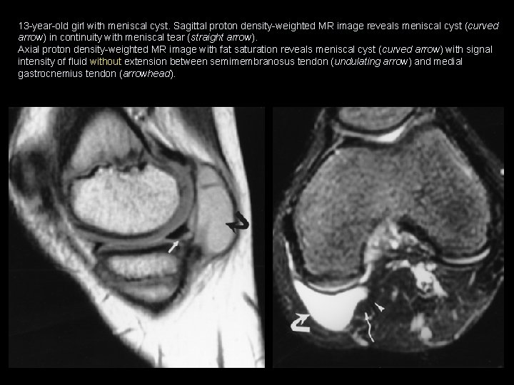 13 -year-old girl with meniscal cyst. Sagittal proton density-weighted MR image reveals meniscal cyst