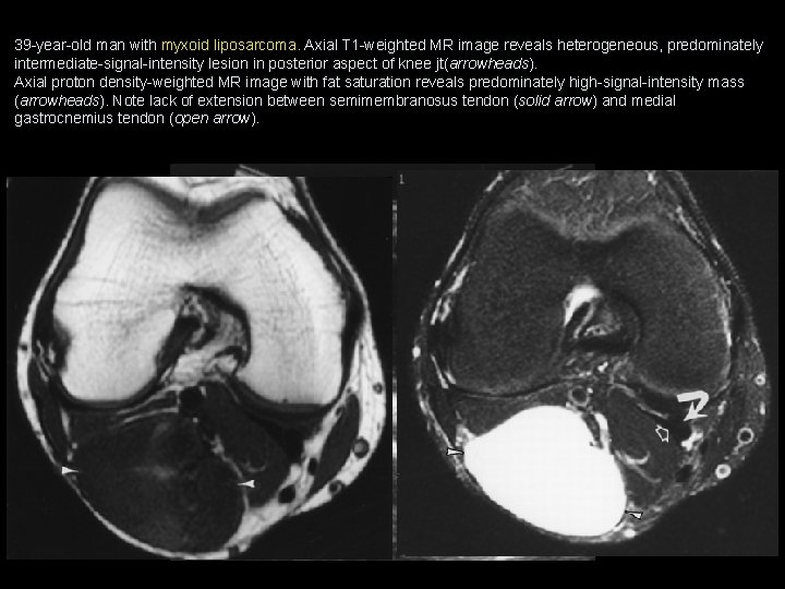 39 -year-old man with myxoid liposarcoma. Axial T 1 -weighted MR image reveals heterogeneous,