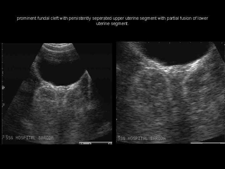 prominent fundal cleft with persistently seperated upper uterine segment with partial fusion of lower