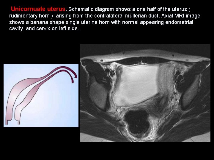  Unicornuate uterus. Schematic diagram shows a one half of the uterus ( rudimentary