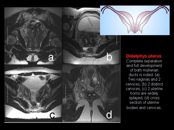 Didelphys uterus. Complete separation and full development of both müllerian ducts is noted. (a)