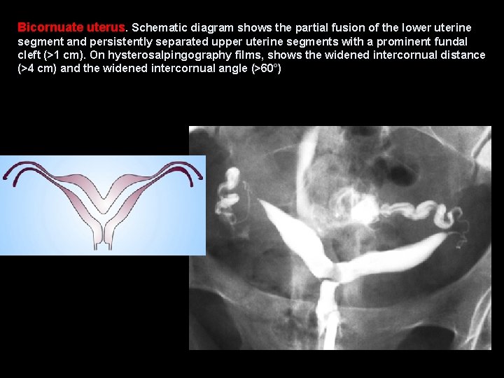 Bicornuate uterus. Schematic diagram shows the partial fusion of the lower uterine segment and