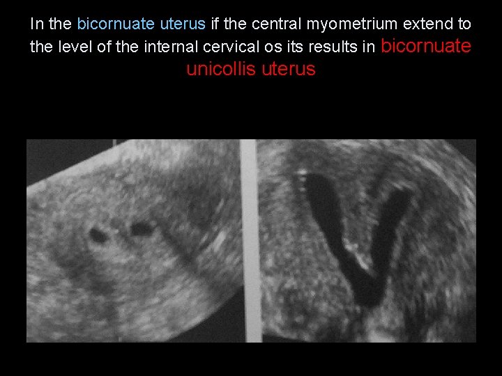 In the bicornuate uterus if the central myometrium extend to the level of the