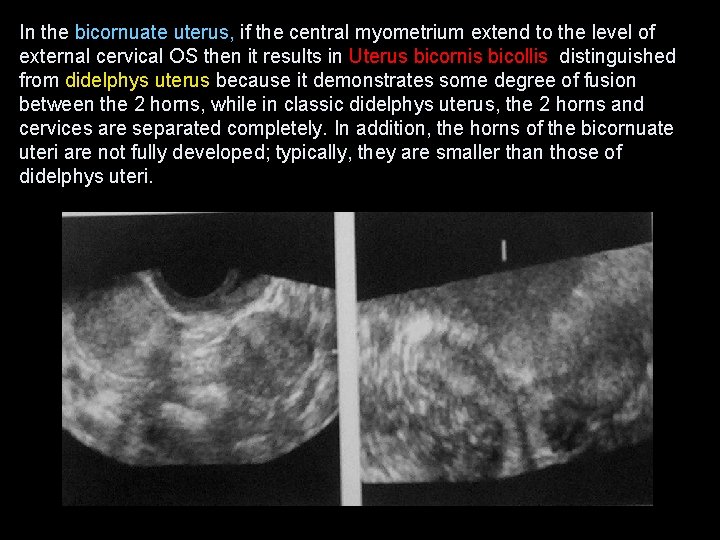 In the bicornuate uterus, if the central myometrium extend to the level of external