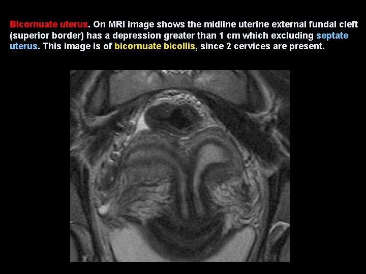 Bicornuate uterus. On MRI image shows the midline uterine external fundal cleft (superior border)