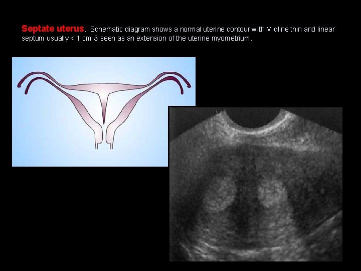 Septate uterus. Schematic diagram shows a normal uterine contour with Midline thin and linear