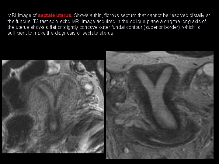 MRI image of septate uterus. Shows a thin, fibrous septum that cannot be resolved