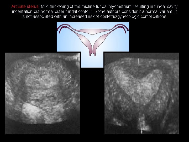 Arcuate uterus. Mild thickening of the midline fundal myometrium resulting in fundal cavity indentation