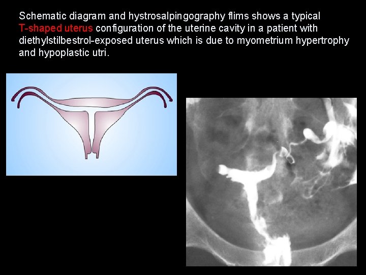 Schematic diagram and hystrosalpingography flims shows a typical T-shaped uterus configuration of the uterine