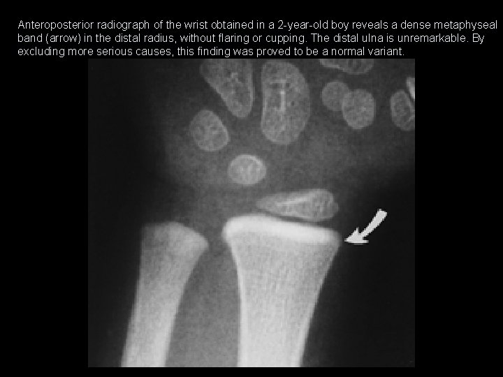 Anteroposterior radiograph of the wrist obtained in a 2 -year-old boy reveals a dense