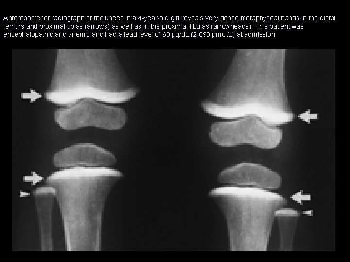 Anteroposterior radiograph of the knees in a 4 -year-old girl reveals very dense metaphyseal