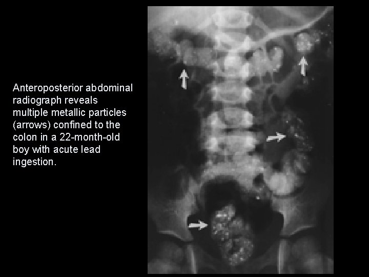 Anteroposterior abdominal radiograph reveals multiple metallic particles (arrows) confined to the colon in a