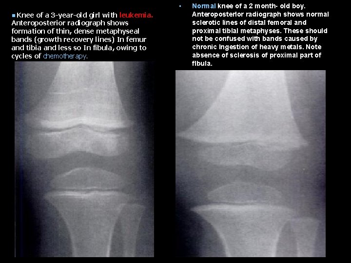  • Knee of a 3 -year-old girl with leukemia. Anteroposterior radiograph shows formation