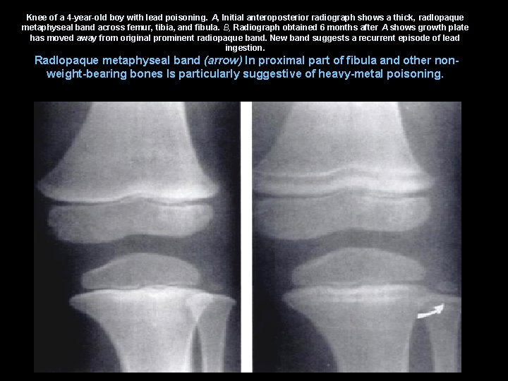Knee of a 4 -year-old boy with lead poisoning. A, Initial anteroposterior radiograph shows