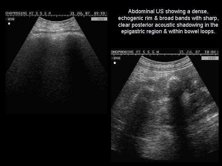 Abdominal US showing a dense, echogenic rim & broad bands with sharp, clear posterior