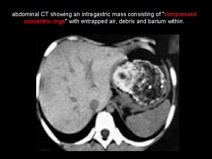 abdominal CT showing an intragastric mass consisting of "compressed concentric rings" with entrapped air,