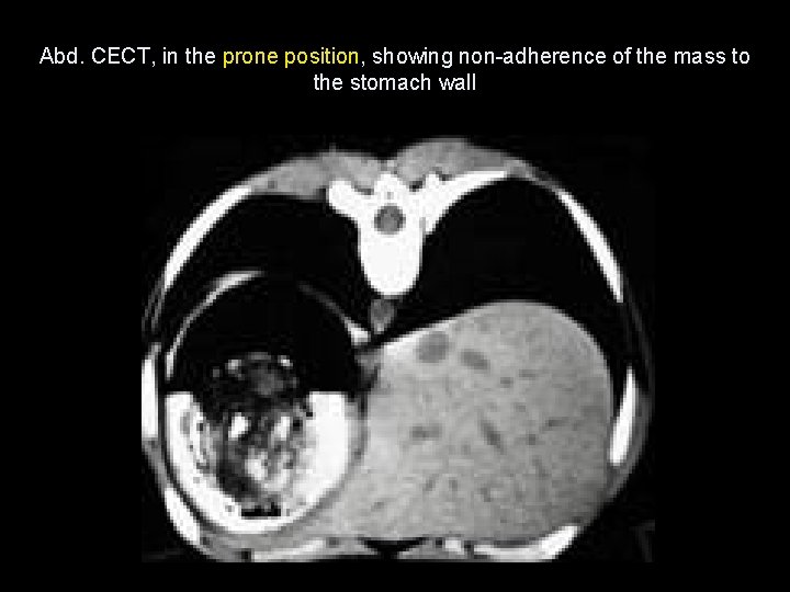 Abd. CECT, in the prone position, showing non-adherence of the mass to the stomach