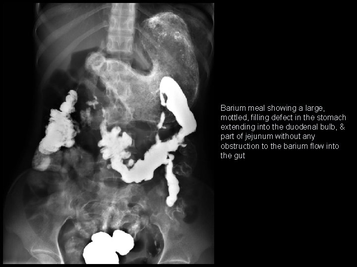 Barium meal showing a large, mottled, filling defect in the stomach extending into the