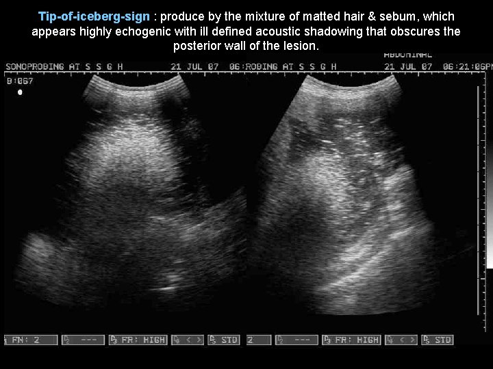 Tip-of-iceberg-sign : produce by the mixture of matted hair & sebum, which appears highly