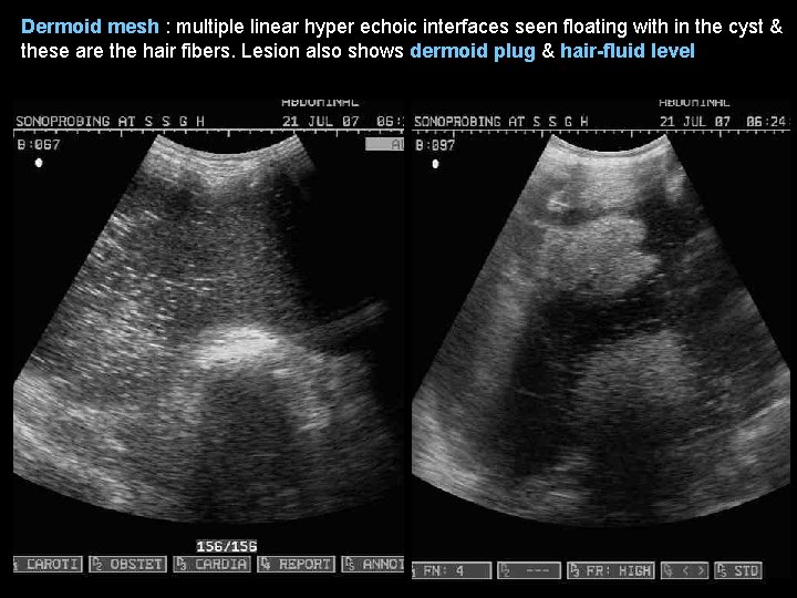 Dermoid mesh : multiple linear hyper echoic interfaces seen floating with in the cyst