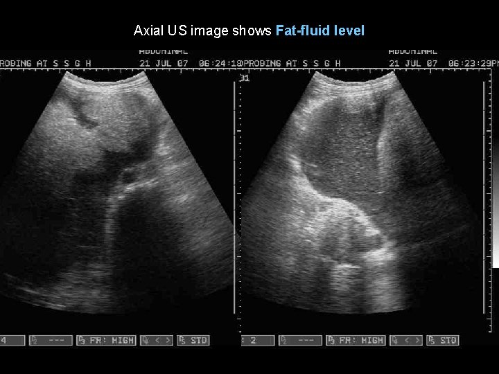 Axial US image shows Fat-fluid level 