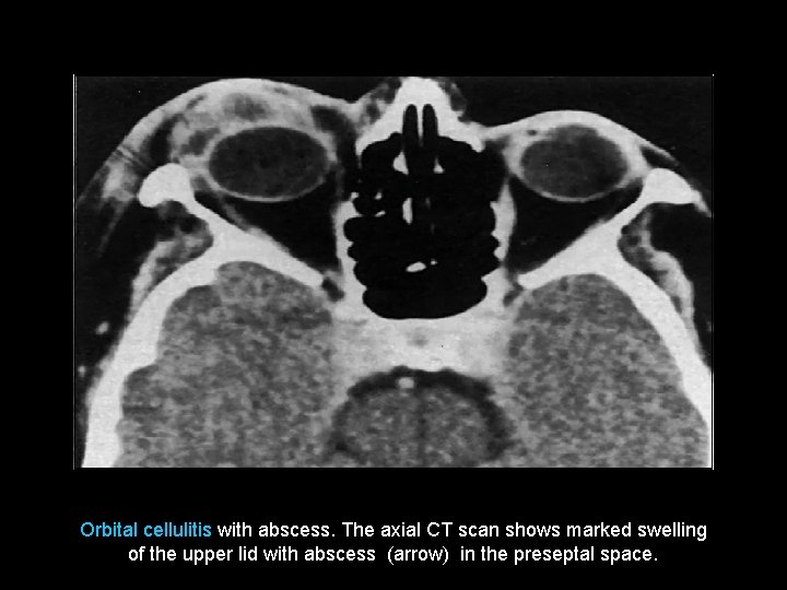 Orbital cellulitis with abscess. The axial CT scan shows marked swelling of the upper