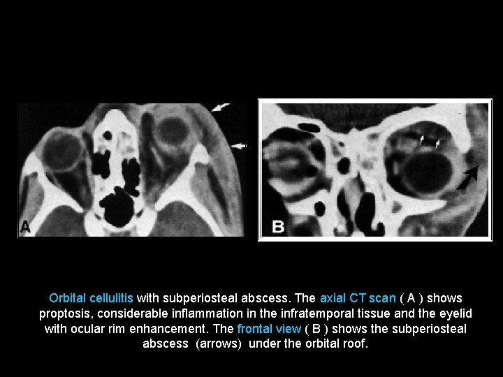 Orbital cellulitis with subperiosteal abscess. The axial CT scan ( A ) shows proptosis,