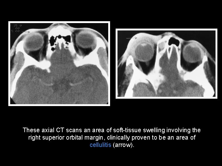 These axial CT scans an area of soft-tissue swelling involving the right superior orbital